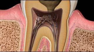 Root Canal Therapy