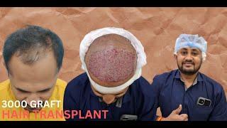 Hair Transplant in Ujjain | Best Results & Cost of Hair Transplant in Ujjain