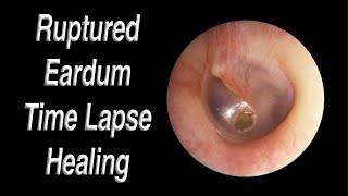 Ruptured Eardrum Healing Closed Time Lapse - A Hole in Eardrum Usually Heals Closed on Its Own!