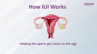 Intrauterine Insemination (IUI) Procedure Helps Couples In Achieving Their Parenthood Dream.