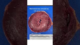 The Effect of High Blood Pressure on the Heart #autopsy #hypertension #forensics #health