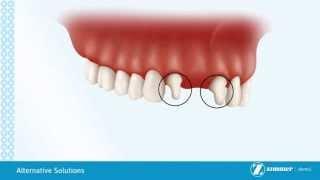 Alternatives to Dental Implants