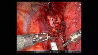 Cerfolio Surgery: L Main-Stem Sleeve Resection with Trachea & Carina on ECMO from Right Chest