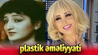 Azərbaycan müğənniləri plastik əməliyyatdan əvvəl - sonra