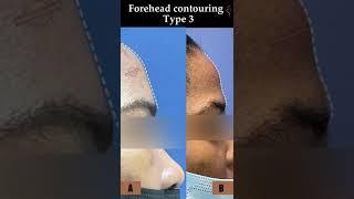 Forehead Contouring Type 3 | #shorts | #youtubeshorts