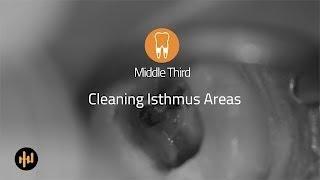 Helse Ultrasonic Endo - Middle Third - Cleaning Isthmus Areas