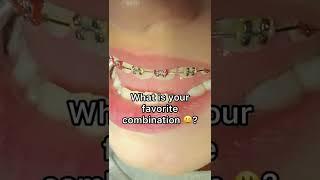 Changing braces colors - How often can I change braces colors? - Tooth Time Dentist New Braunfels