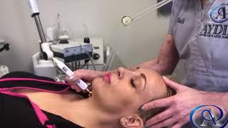 Pelleve Skin Tightening with Heidi