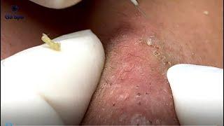 If You Like Squeezing Acnes, You'll Must be See This Video | Full 33 Minutes | GaSpa 18.03.2022