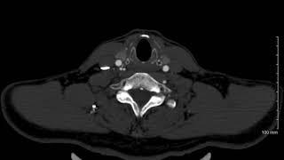 Vertebral duplicated ascending pharyngeal arteries CTA axials