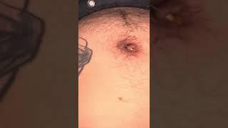 Navel torture - removing needle