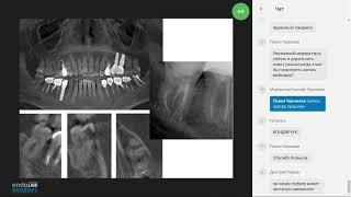 Endo.Education Вебинар Евгения Платонова "Альтернатива в обработке корневых каналов зуба"