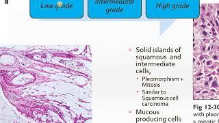 Malignant salivary gland tumour