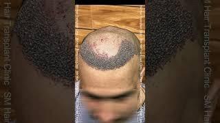 FUE Hair Transplant Journey | SM Hair Transplant Clinic | Panipat | Shamli