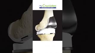 Total Knee Replacement (TKR)