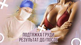 ПОДТЯЖКА ГРУДИ + ЛИПОФИЛИНГ = РЕЗУЛЬТАТ ДО/ПОСЛЕ #абриелль #левицкая #санкт-петербург