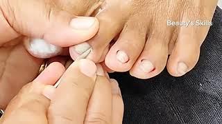 Satisfying pedicure|Ingrown removal(Part81) | Beauty's Skills