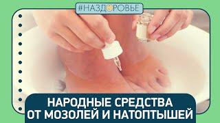 #НАЗДОРОВЬЕ: народные средства от мозолей