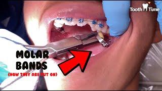 Braces on - Molar Bands - Tooth Time Family Dentistry