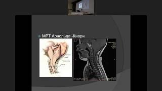 Spina bifida: от антенатального до подросткового периода. Зиненко Д.Ю.