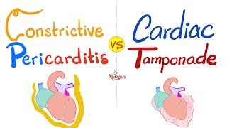 Constrictive Pericarditis vs. Cardiac Tamponade - Cardiology Series