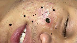 How Doctors Remove Acne From Face # 026