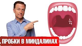 Гнойные пробки в миндалинахкак предотвратить их появление