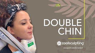 Double Chin Coolsculpting