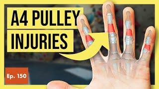 A4 Pulley Injuries in Rock Climbers (Causes, Risks, & Full Recovery)