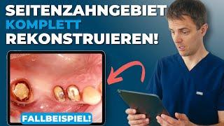 Rekonstruktion einer Seitenzahnreihe mit Implantat und Sinuslift | Fallbeispiel