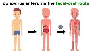 Poliomyelitis (Poliovirus)