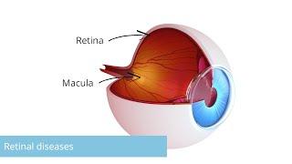 Retinal diseases: Causes, symptoms, diagnosis & treatment. Essentials in 3 minutes. Eye surgery.