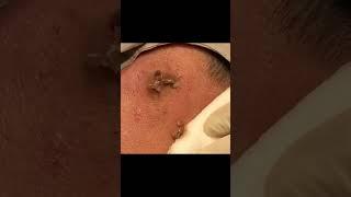 A Never Ending Sac Cyst