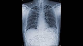 Barium Swallow #shortsvideo