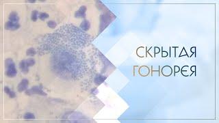  Скрытая гонорея. Клинический случай №51