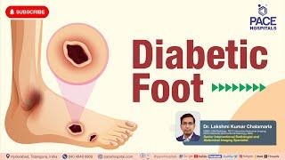 Diabetic Foot - Stages, Causes, Symptoms, Diagnosis, Prevention & Treatment | Diabetic Foot Ulcers