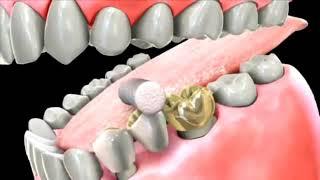 How does a dental bridge look?