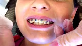 ELASTIC MODULES IN ORTHODONTIC TREATMENT - How To Use -  DENTBEAR