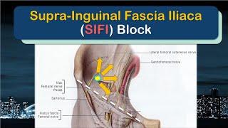 Supra-Inguinal Fascia Iliaca (SIFI) Block - the SUPRA-INGUINAL approach