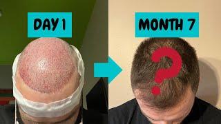 FUE Hair Transplant 7 month update | SMILE Hair Clinic, Istanbul