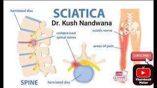 Truth About Sciatica/Backache Treatment #viral #ytshorts