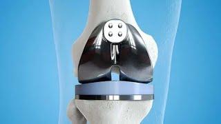 TKR/Total knee replacement #TKR #kneereplacement #exercise #physiotherapy