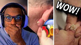 A VIEWER SENT ME AN EAR PIMPLE POPPING VIDEO!