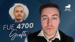 4700 Grafts Hair Transplant | 12-Month Amazing Results | Before & After Transformation