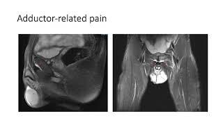 Groin pain in Football