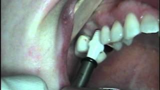 Z Look Metal Free Dental Implants at The Lanap and Implant Center Of Pennsylvania