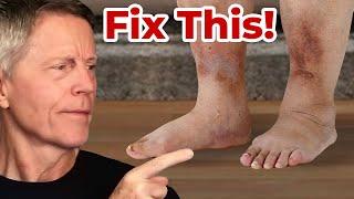 #1 Best Way to Heal Swollen Feet (feat. Dr. Vega)