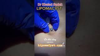 Video out now massive blackhead extraction #skincare #blackheadremoval #blackheads Dr Khaled Sadek