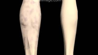 Deep Venous Thrombosis (DVT): Signs and Symptoms Animation by Cal Shipley, M.D.