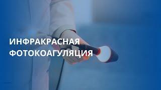 Инфракрасная фотокоагуляция